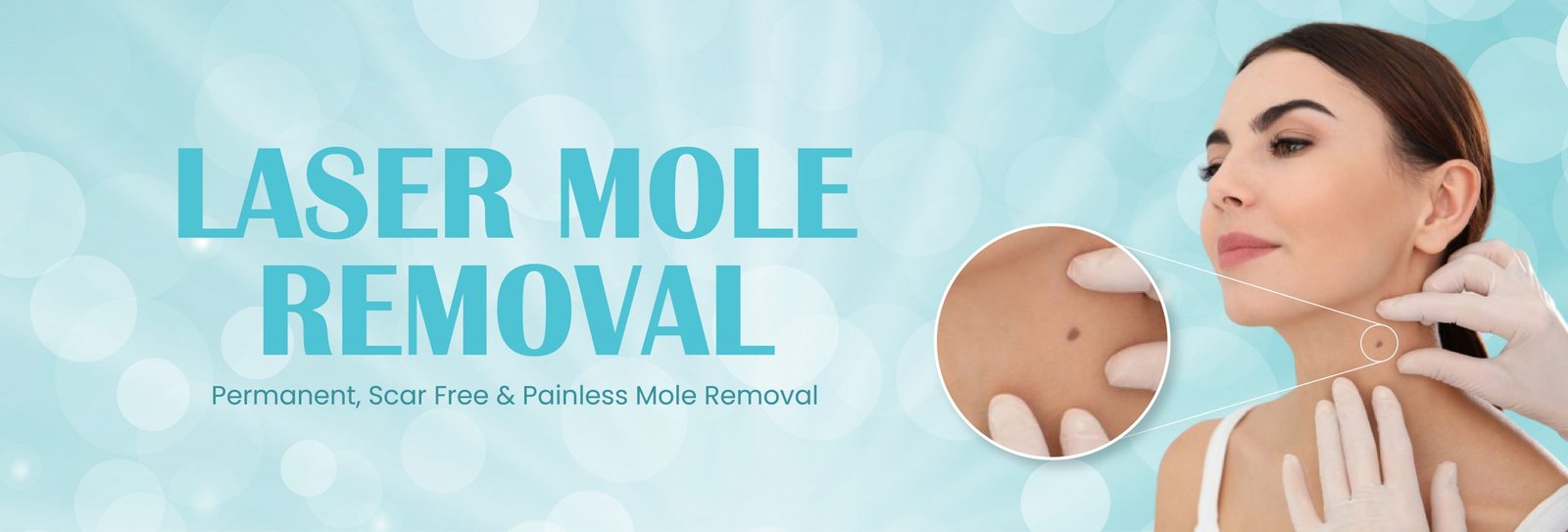 Mole Removal