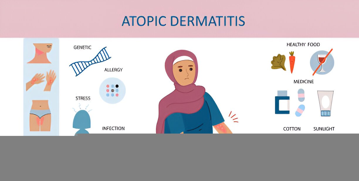 Atopic Dermatitis