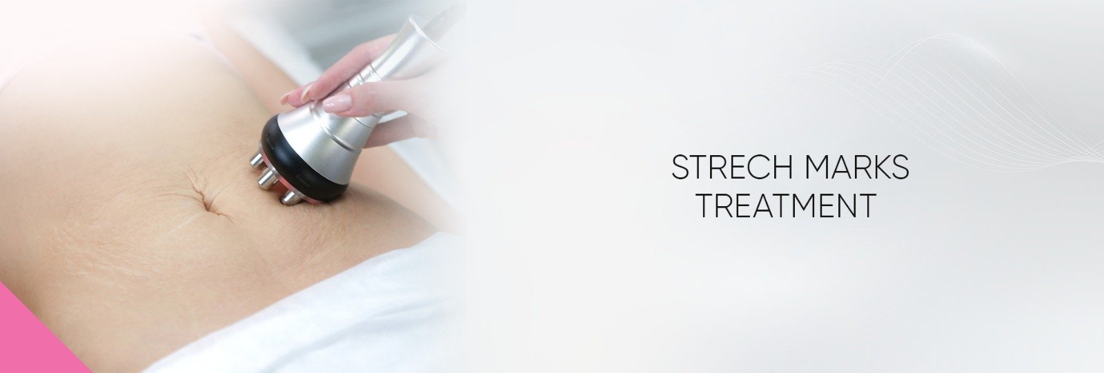 Laser Stretch Marks