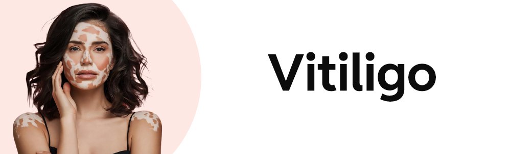 Vitiligo Treatment